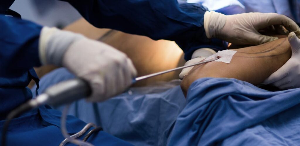 Paciente realizando cirurgia plástica após grande perda de peso